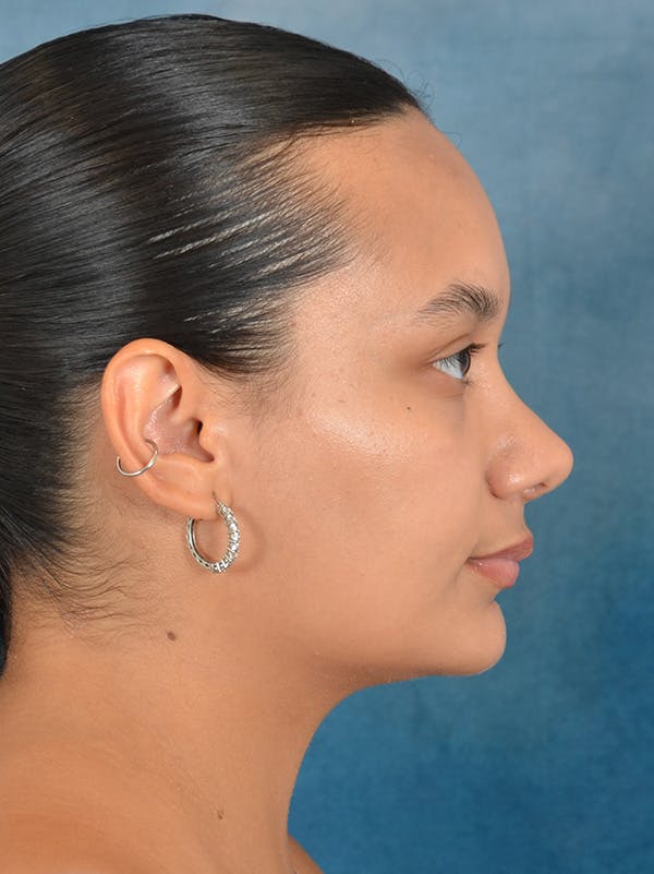 Rhinoplasty Before & After Gallery - Patient 169366042 - Image 10