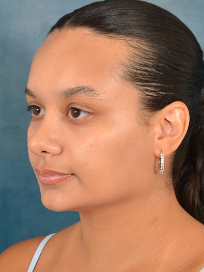 Rhinoplasty Before & After Gallery - Patient 169366042 - Image 4
