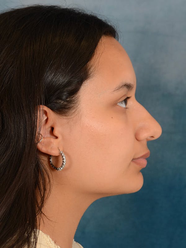 Rhinoplasty Before & After Gallery - Patient 169366042 - Image 9