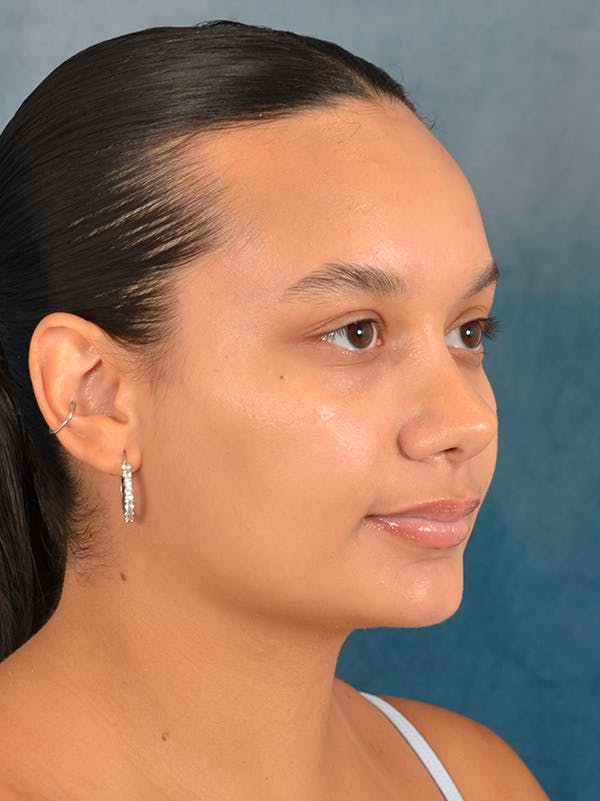 Rhinoplasty Before & After Gallery - Patient 169366042 - Image 8