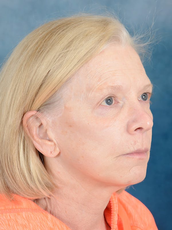 Laser Skin Resurfacing Before & After Gallery - Patient 169365970 - Image 3