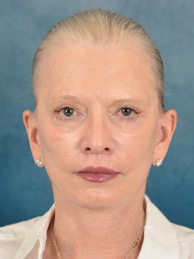 Deep Plane Facelift Before & After Gallery - Patient 169366514 - Image 4