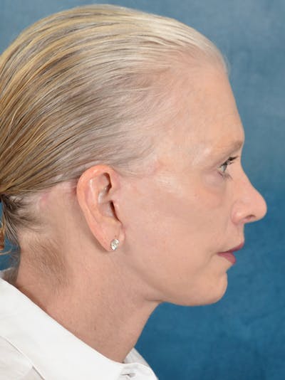 Deep Plane Facelift Before & After Gallery - Patient 169366514 - Image 8