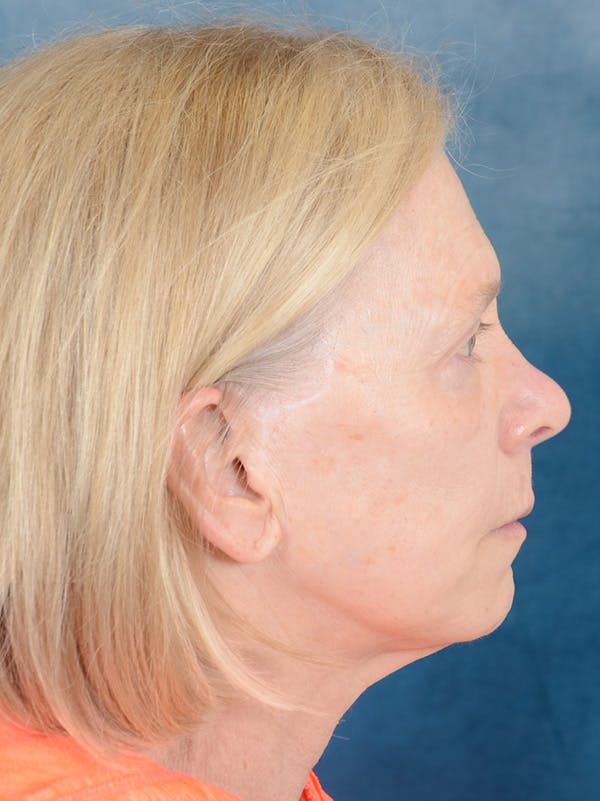 Laser Skin Resurfacing Before & After Gallery - Patient 169365970 - Image 5