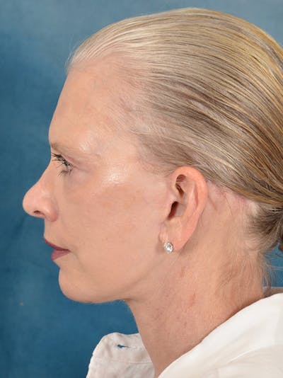Deep Plane Facelift Before & After Gallery - Patient 169366514 - Image 10