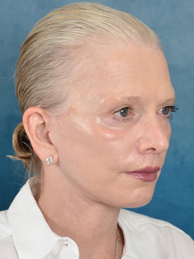 Deep Plane Facelift Before & After Gallery - Patient 169366514 - Image 6