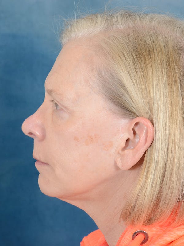 Deep Plane Facelift Before & After Gallery - Patient 169366514 - Image 9