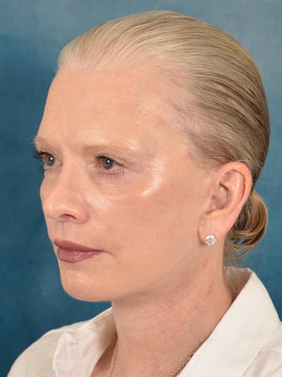 Deep Plane Facelift Before & After Gallery - Patient 169366514 - Image 2