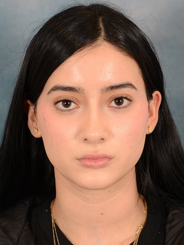Rhinoplasty Before & After Gallery - Patient 169366554 - Image 3