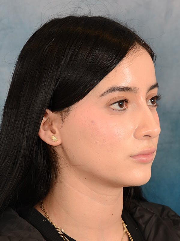 Rhinoplasty Before & After Gallery - Patient 169366554 - Image 5