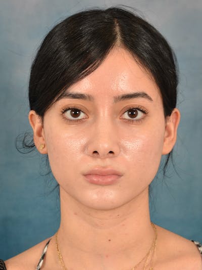 Rhinoplasty Before & After Gallery - Patient 169366554 - Image 4