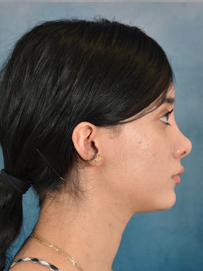 Rhinoplasty Before & After Gallery - Patient 169366554 - Image 8
