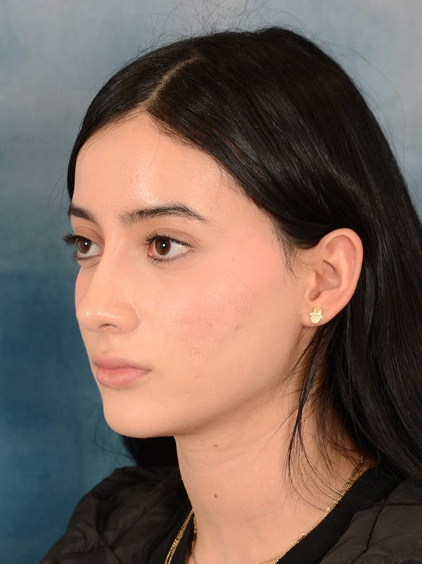 Rhinoplasty Before & After Gallery - Patient 169366554 - Image 9