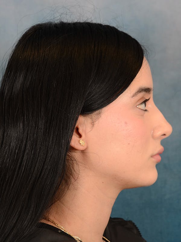 Rhinoplasty Before & After Gallery - Patient 169366554 - Image 7