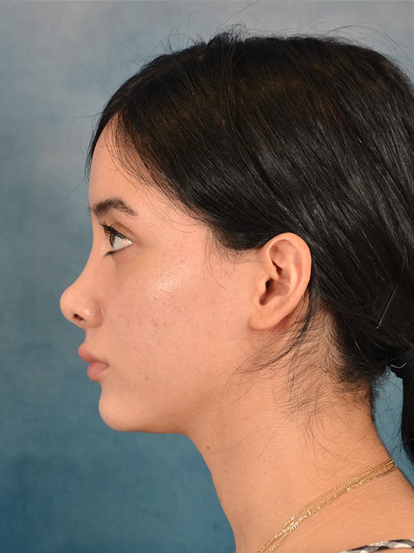 Rhinoplasty Before & After Gallery - Patient 169366554 - Image 2