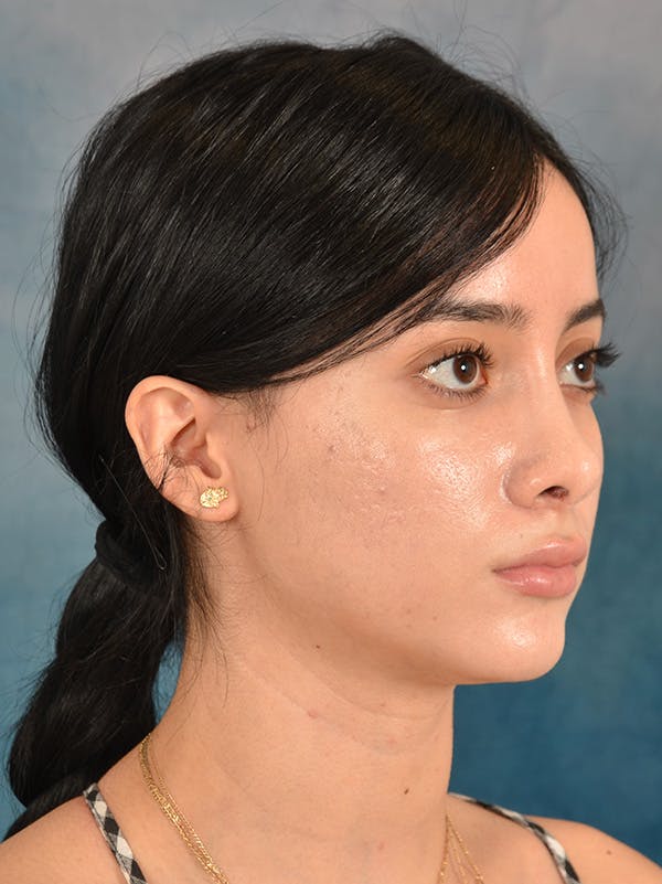 Rhinoplasty Before & After Gallery - Patient 169366554 - Image 6