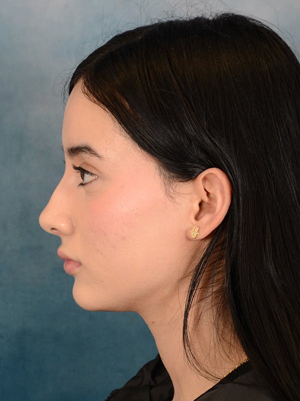 Rhinoplasty Before & After Gallery - Patient 169366554 - Image 1