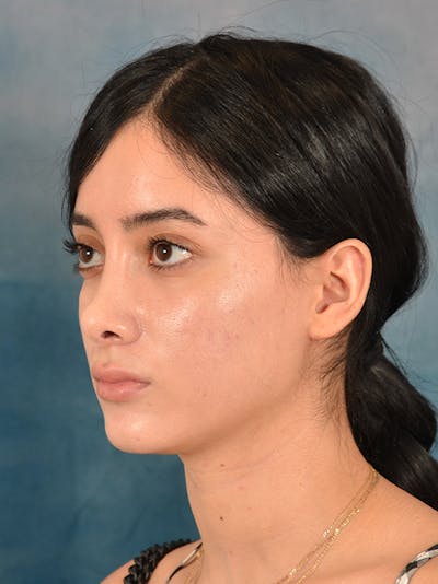 Rhinoplasty Before & After Gallery - Patient 169366554 - Image 10