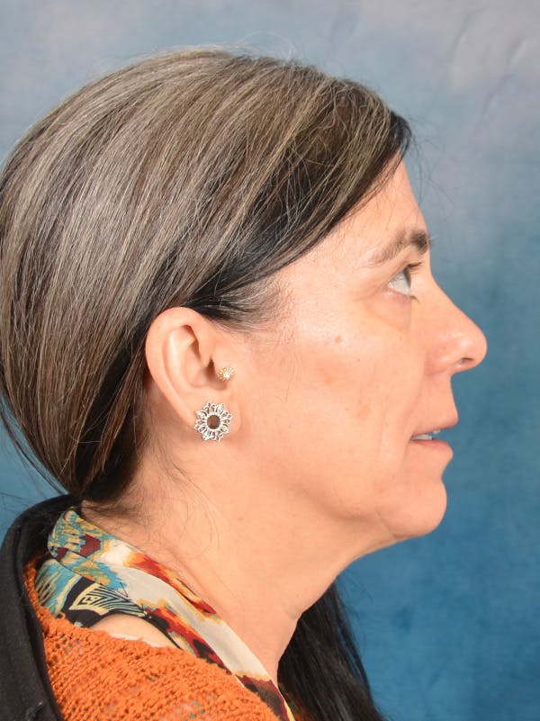 Deep Plane Facelift Before & After Gallery - Patient 169366561 - Image 7