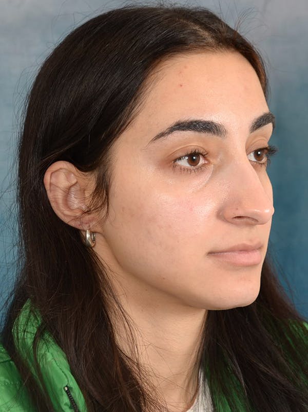 Rhinoplasty Before & After Gallery - Patient 172293943 - Image 7