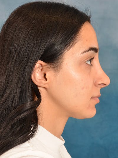 Rhinoplasty Before & After Gallery - Patient 172293943 - Image 10