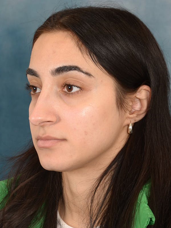 Rhinoplasty Before & After Gallery - Patient 172293943 - Image 3
