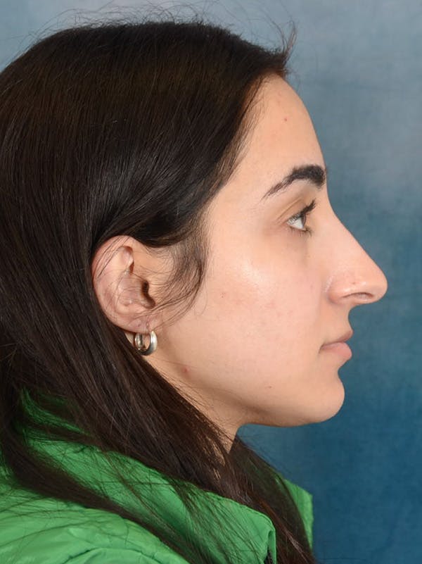 Rhinoplasty Before & After Gallery - Patient 172293943 - Image 9
