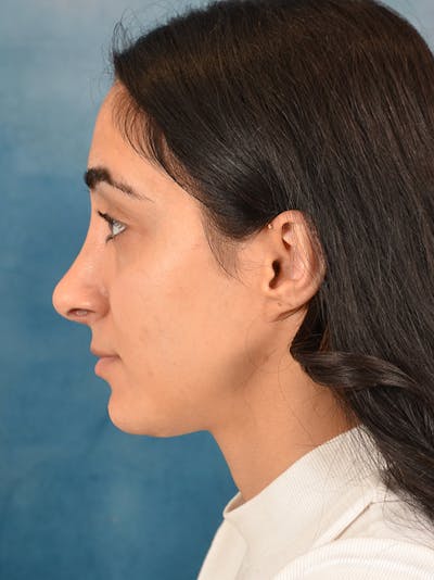 Rhinoplasty Before & After Gallery - Patient 172293943 - Image 2
