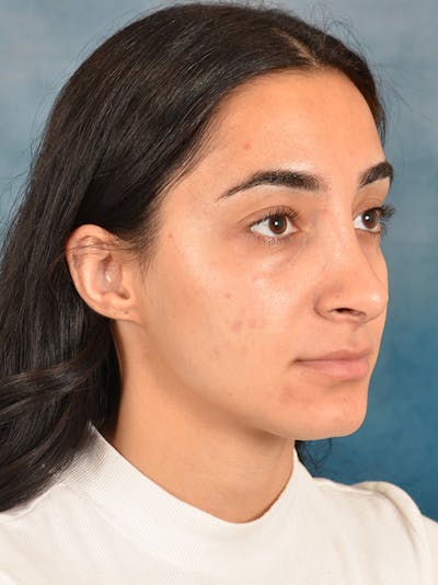 Rhinoplasty Before & After Gallery - Patient 172293943 - Image 8