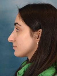 Rhinoplasty Before & After Gallery - Patient 172293943 - Image 1