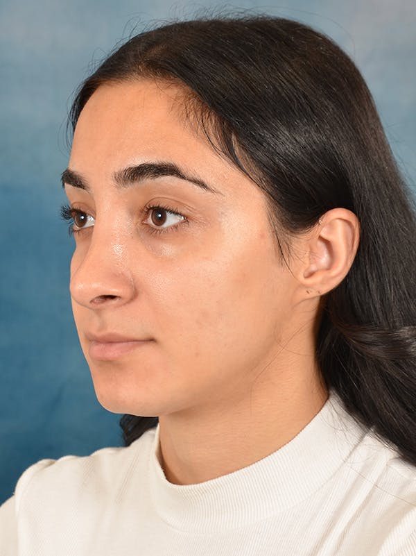 Rhinoplasty Before & After Gallery - Patient 172293943 - Image 4