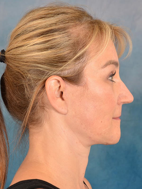 Deep Plane Facelift Before & After Gallery - Patient 169465722 - Image 8