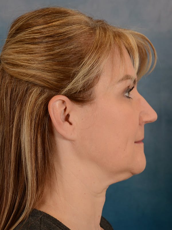 Deep Plane Facelift Before & After Gallery - Patient 169465722 - Image 7