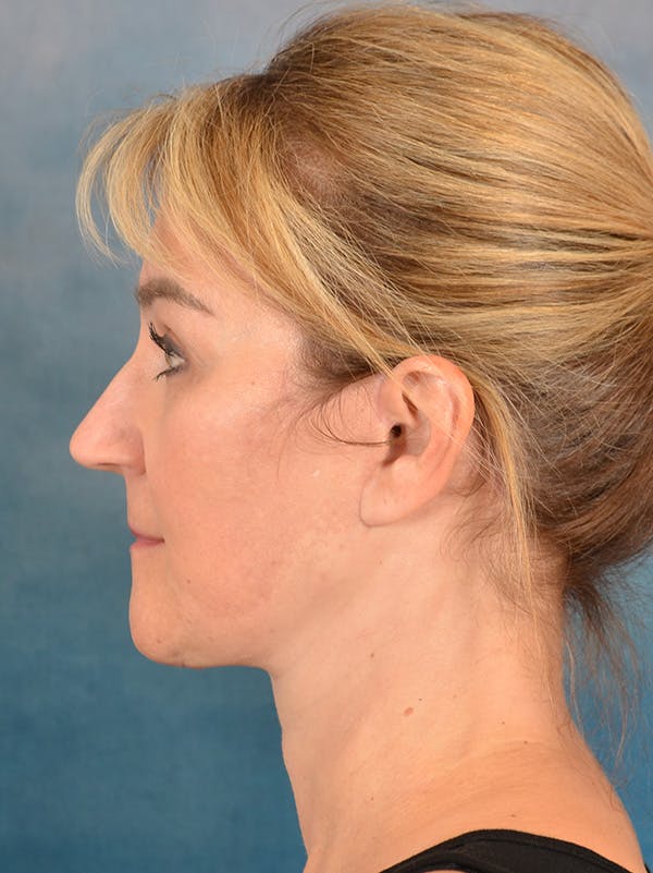 Deep Plane Facelift Before & After Gallery - Patient 169465722 - Image 10
