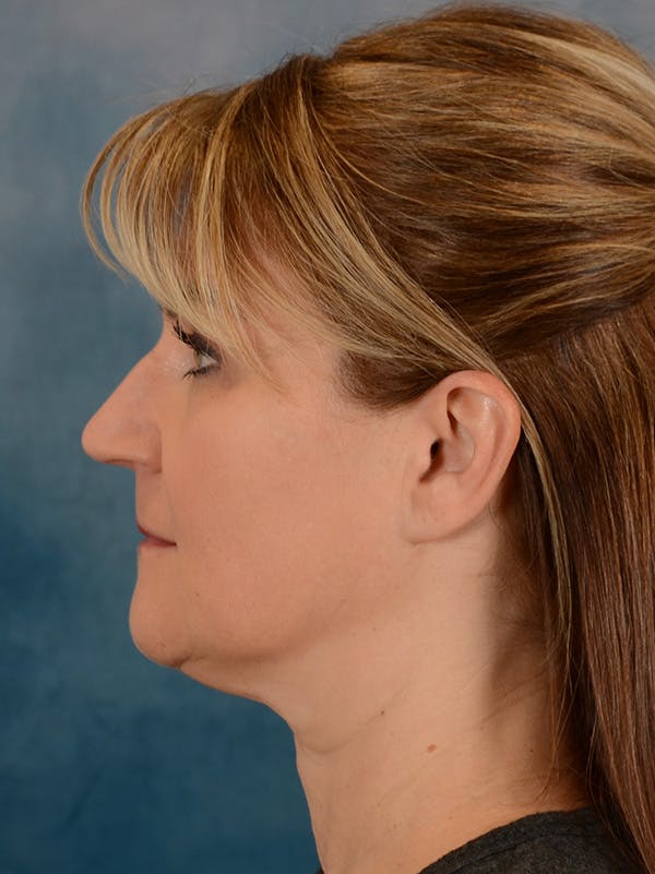 Deep Plane Facelift Before & After Gallery - Patient 169465722 - Image 9