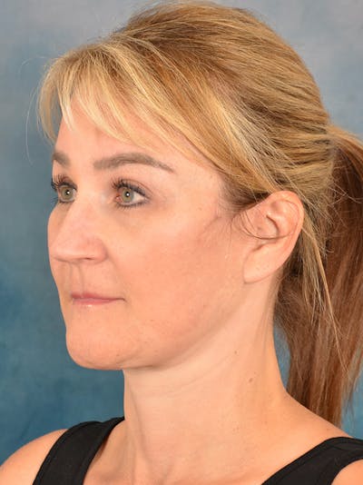 Deep Plane Facelift Before & After Gallery - Patient 169465722 - Image 2