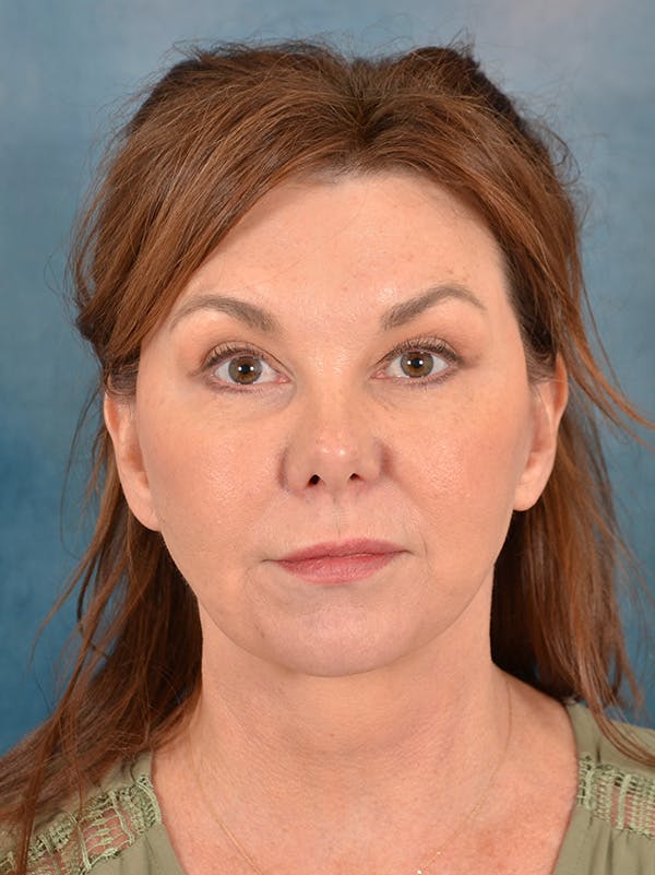 Deep Plane Facelift Before & After Gallery - Patient 172295053 - Image 2