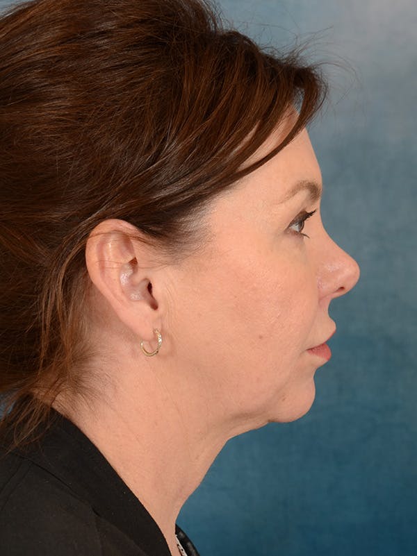 Deep Plane Facelift Before & After Gallery - Patient 172295053 - Image 5