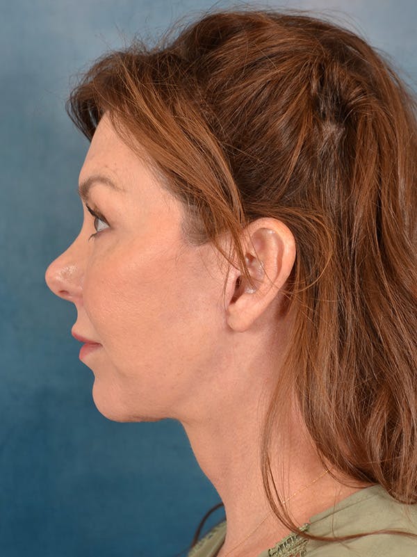 Deep Plane Facelift Before & After Gallery - Patient 172295053 - Image 10