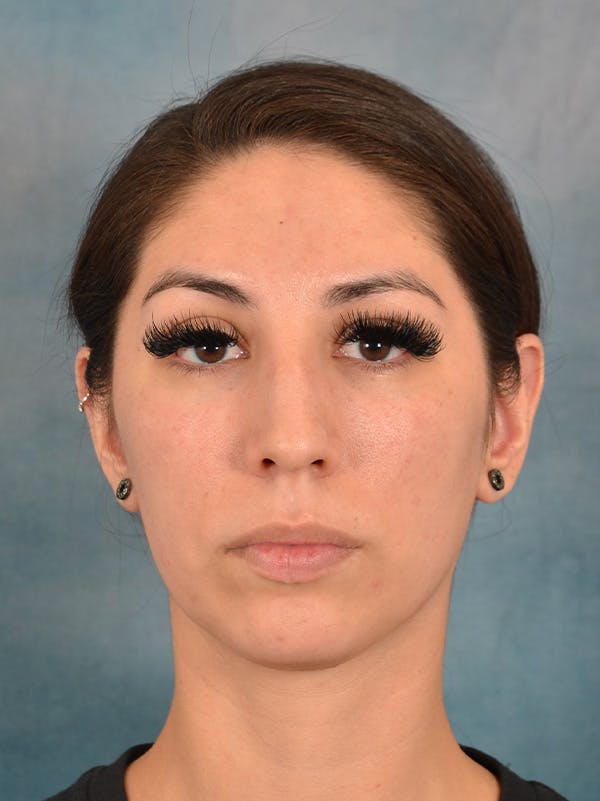 Rhinoplasty Before & After Gallery - Patient 172294836 - Image 3