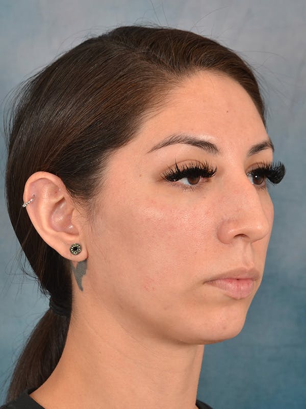 Rhinoplasty Before & After Gallery - Patient 172294836 - Image 5