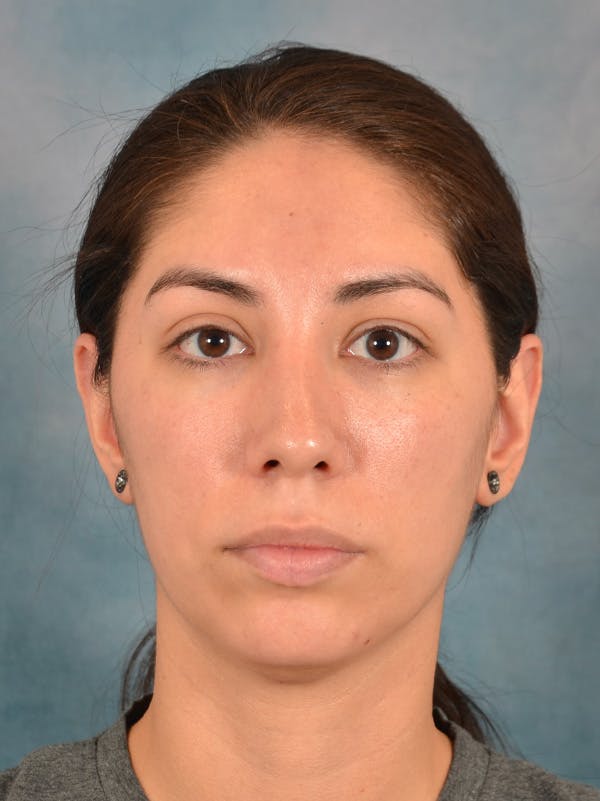 Rhinoplasty Before & After Gallery - Patient 172294836 - Image 4