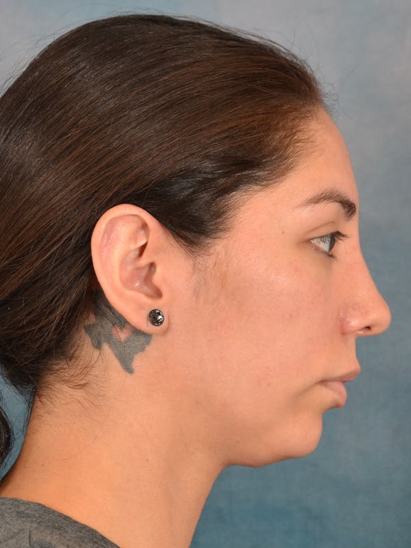 Rhinoplasty Before & After Gallery - Patient 172294836 - Image 8