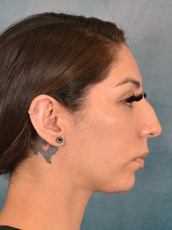 Rhinoplasty Before & After Gallery - Patient 172294836 - Image 7