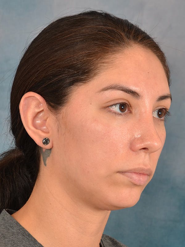 Rhinoplasty Before & After Gallery - Patient 172294836 - Image 6