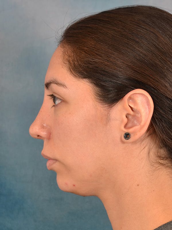 Rhinoplasty Before & After Gallery - Patient 172294836 - Image 2