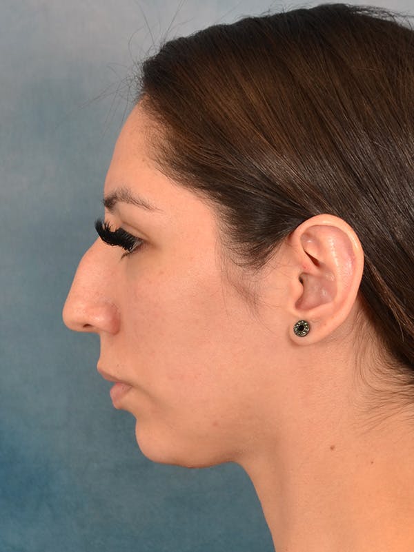 Rhinoplasty Before & After Gallery - Patient 172294836 - Image 1