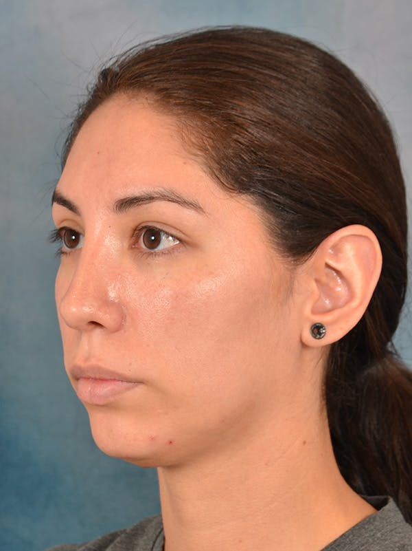 Rhinoplasty Before & After Gallery - Patient 172294836 - Image 9