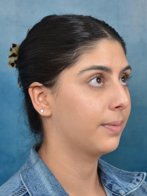 Rhinoplasty Before & After Gallery - Patient 172294930 - Image 5