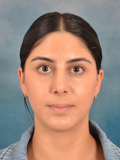 Rhinoplasty Before & After Gallery - Patient 172294930 - Image 4